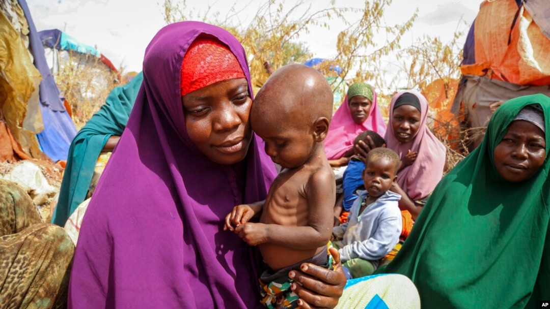 FILE - Nunay Mohamed, 25, who fled the drought-stricken Lower Shabelle area, holds her 1-year-old malnourished child at a makeshift camp for the displaced near Mogadishu, Somalia, June 30, 2022.
