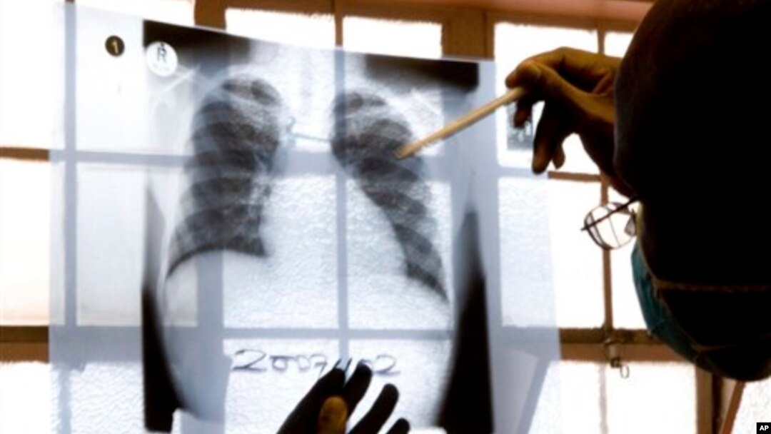 FILE - A doctor examines chest X-rays at a tuberculosis clinic in Gugulethu, Cape Town, South Africa, Jan. 17, 2014. 